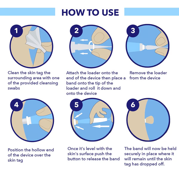 Kit Auto pour Retrait de Verrues - Enlèvement Facile à Domicile