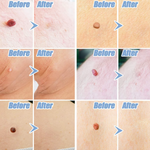 Kit Auto pour Retrait de Verrues - Enlèvement Facile à Domicile