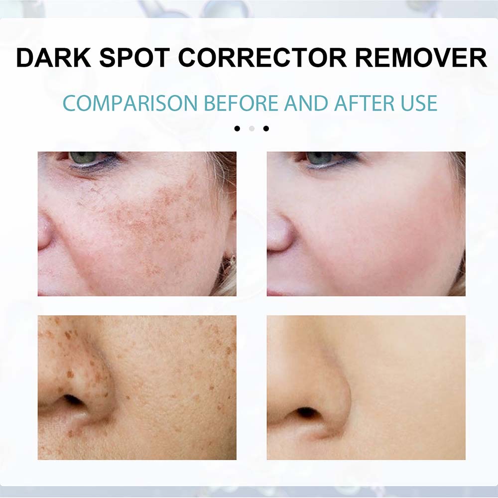 Anti-Dark Spot Cream for Pigmentation Lightening