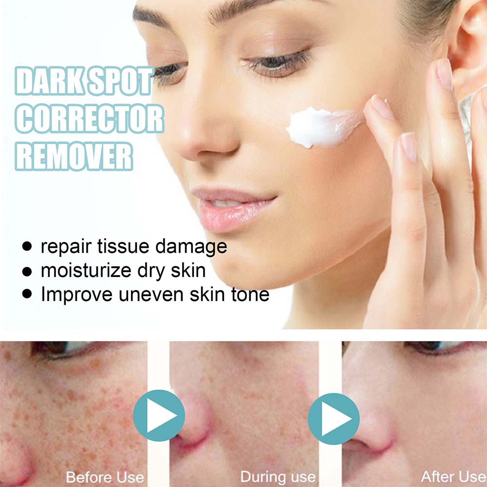 Anti-Dark Spot Cream for Pigmentation Lightening
