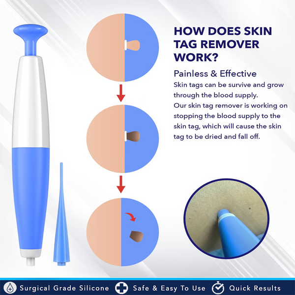 Kit Auto pour Retrait de Verrues - Enlèvement Facile à Domicile
